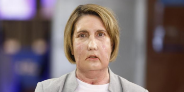 El Hospital Vall d’Hebron de Barcelona realiza el primer trasplante de cara