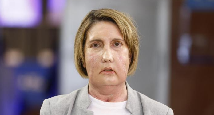 El Hospital Vall d’Hebron de Barcelona realiza el primer trasplante de cara